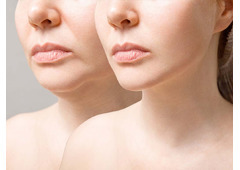 What Are the Key Benefits of Choosing Dermal Fillers?