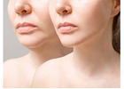 What Are the Key Benefits of Choosing Dermal Fillers?